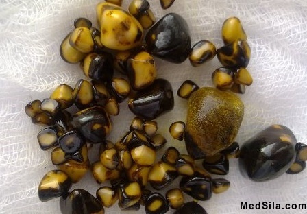 Смешанные камни желчного пузыря