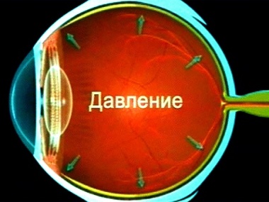 Повышение внутриглазного давления