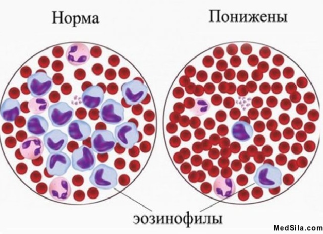 Изменение количества эозинофилов